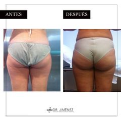 Liposucción - Clínica Dr. Jiménez