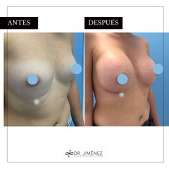 Aumento de pecho - Clínica Dr. Jiménez