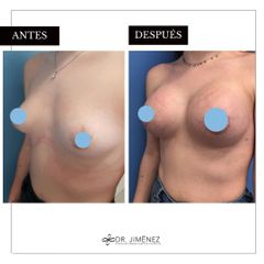Aumento de pecho - Clínica Dr. Jiménez