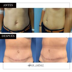 Abdominoplastia - Clínica Dr. Jiménez