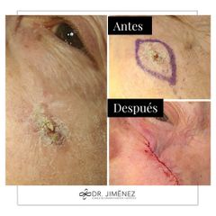 Verrugas - Clínica Dr. Jiménez