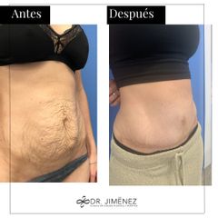 Abdominoplastia - Clínica Dr. Jiménez