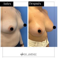 Aumento de pecho - Clínica Dr. Jiménez