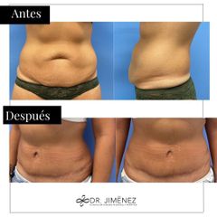 Abdominoplastia - Clínica Dr. Jiménez