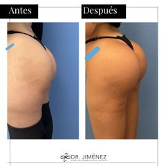 Aumento glúteos - Clínica Dr. Jiménez