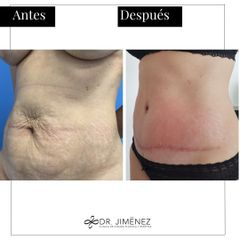 Abdominoplastia - Clínica Dr. Jiménez
