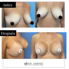 Aumento de pecho - Clínica Dr. Jiménez