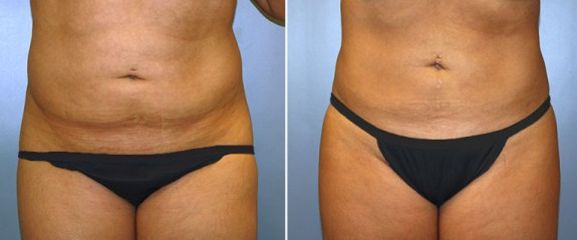 Abdominoplastia - Clínica Dr. Jiménez