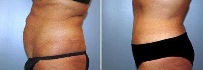 Abdominoplastia - Clínica Dr. Jiménez