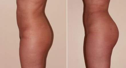 Aumento glúteos - Clínica Dr. Jiménez