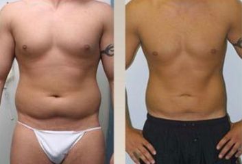 Lipoescultura - Clínica Dr. Jiménez