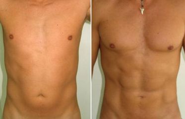 Lipoescultura - Clínica Dr. Jiménez