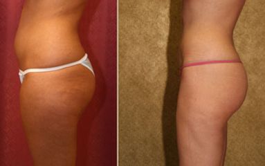 Lipoescultura - Clínica Dr. Jiménez