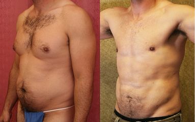 Lipoescultura - Clínica Dr. Jiménez
