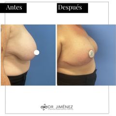 Reducción senos - Clínica Dr. Jiménez