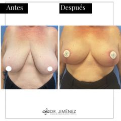 Reducción de senos - Clínica Dr. Jiménez