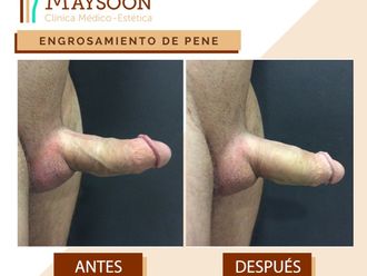 Engrosamiento de pene antes y después - 649927