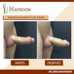 Antes y después Engrosamiento Pene lateral