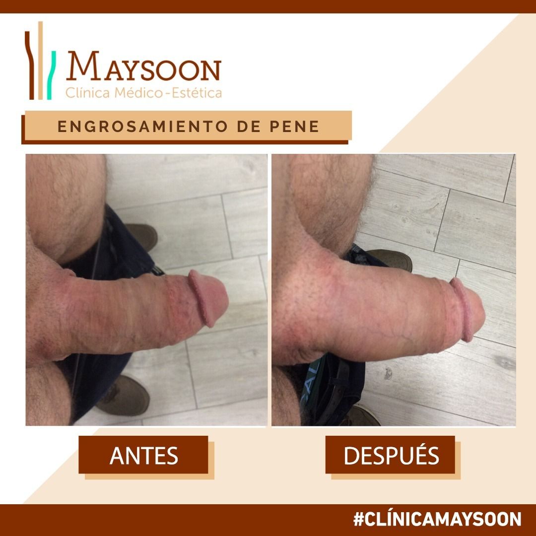 Engrosamiento de pene Antes y después - Multiestetica.com -  Multiestetica.com