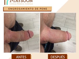 Engrosamiento de pene - 649930