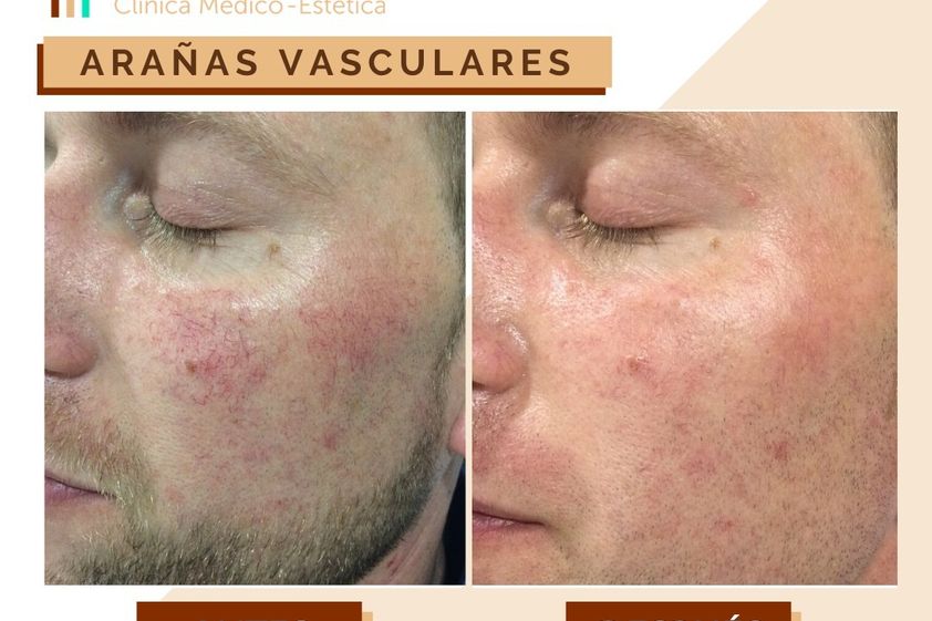 Láser vascular antes y después - 649934