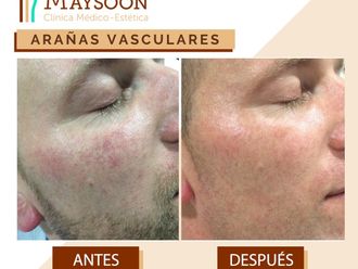 Láser vascular - 649935