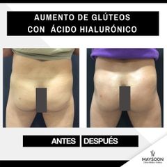 Aumento de glúteos - Clínica Maysoon