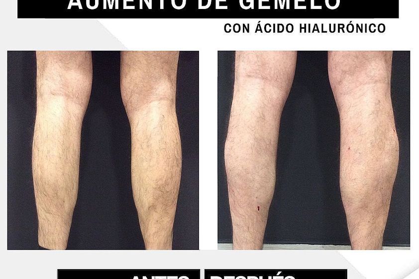 Aumento gemelos antes y después - 790564