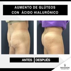 Aumento glúteos - Clínica Maysoon