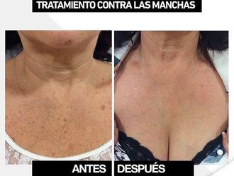 Tratamiento antimanchas - 800663