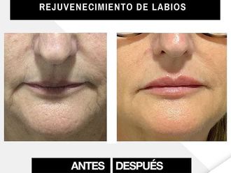 Aumento labios - 800677