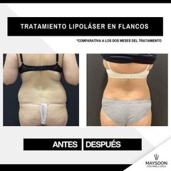 Lipoláser - Clínica Maysoon