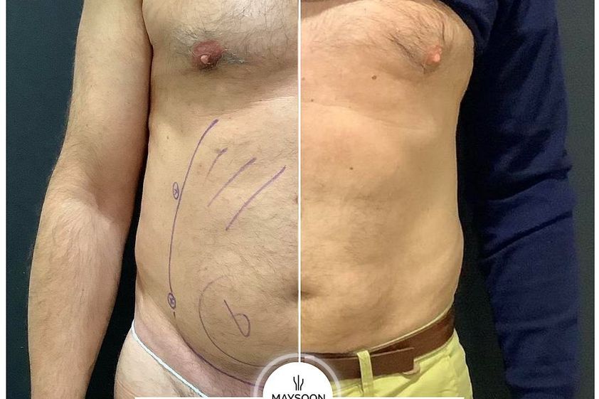 Lipoláser antes y después - 813993
