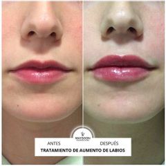 Aumento de labios - Clínica Maysoon