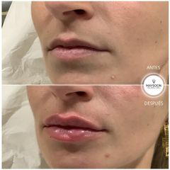 Aumento de labios - Clínica Maysoon