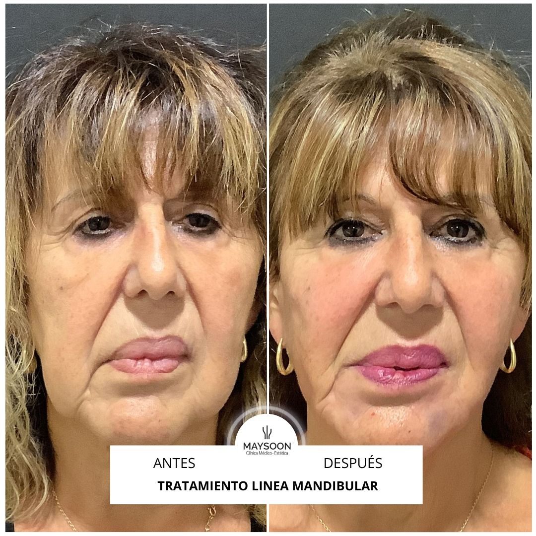 Lipoláser Antes y después