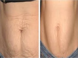 Antes y después Abdominoplastia