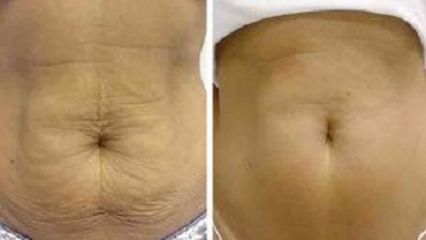 Antes y después Abdominoplastia