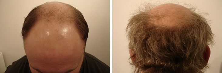 Antes y después tratamiento alopecia 