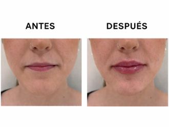 Aumento labios antes y después - 879596
