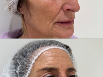 Rejuvenecimiento facial antes y después - 879597