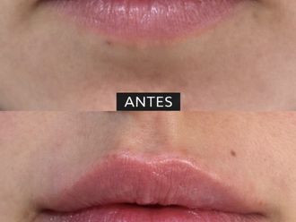 Aumento labios antes y después - 879604