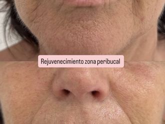 Rejuvenecimiento facial antes y después - 879695