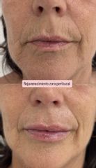 HR Clinic - Rejuvenecimiento facial