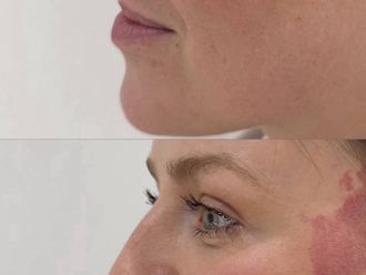 Aumento labios antes y después - 879698