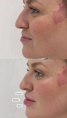 HR Clinic - Aumento de labios