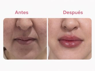 Aumento labios antes y después - 879700