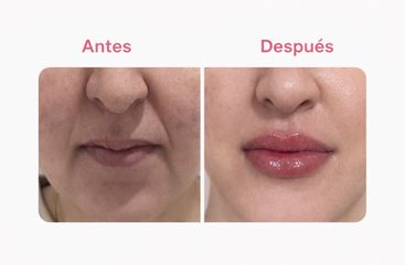 HR Clinic - Aumento de labios