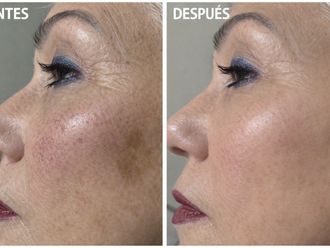 Láser vascular antes y después - 879701