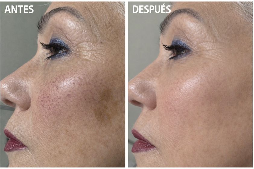 Láser vascular antes y después - 879701